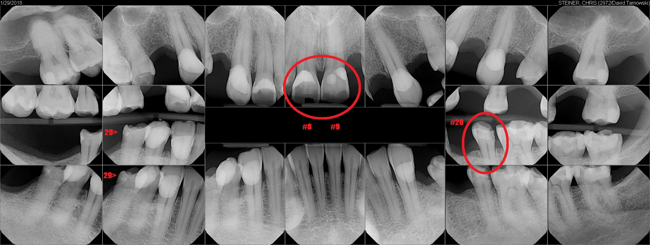 HealthNow Dental (Dr. Tarnowski) X-rays, January 29, 2018 - highlighted