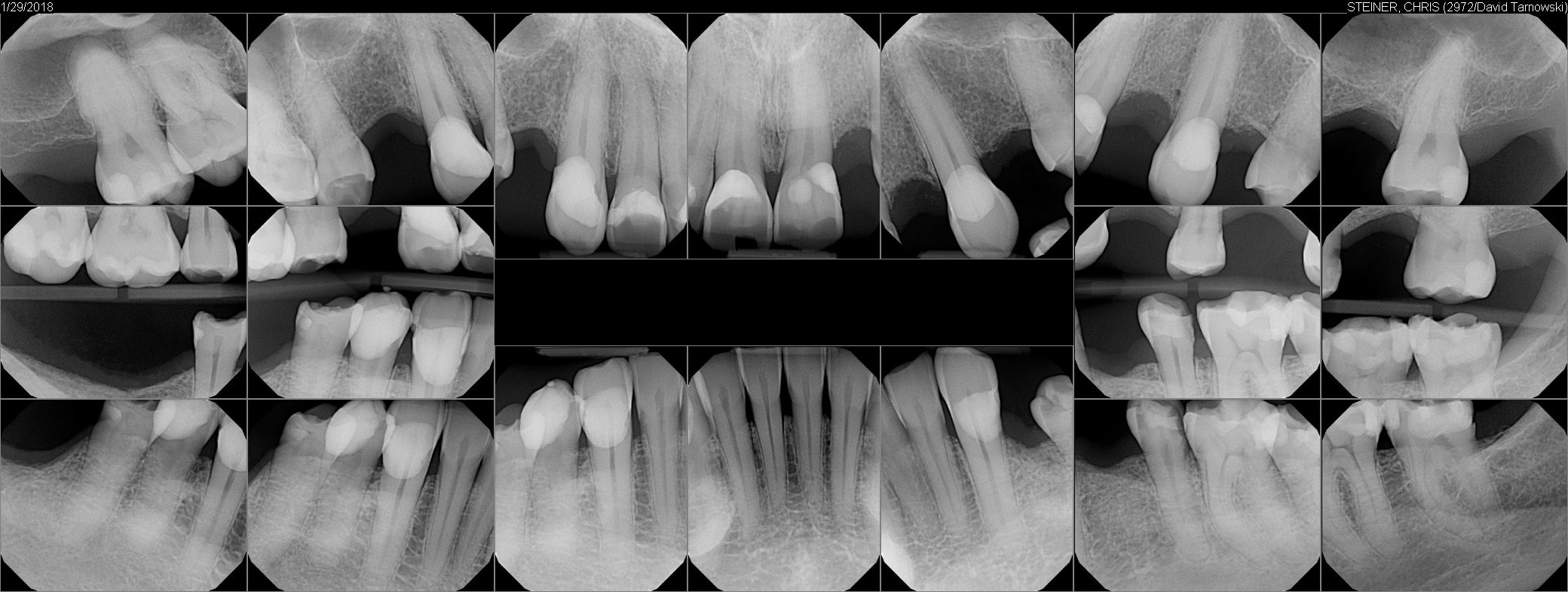 HealthNow Dental (Dr. Tarnowski) X-rays, January 29, 2018